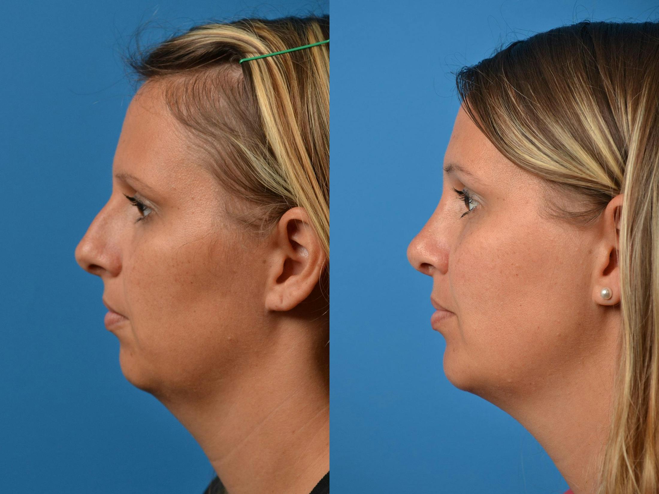 Rhinoplasty Before & After Gallery - Patient 122406872 - Image 4