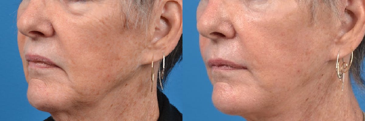 Lip Lift Before & After Gallery - Patient 122406874 - Image 2