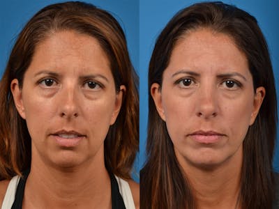 Rhinoplasty Before & After Gallery - Patient 122406877 - Image 1