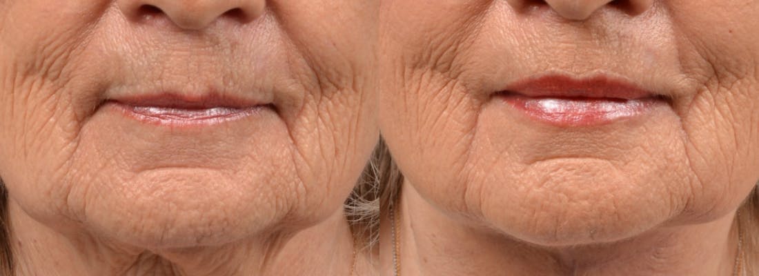 Lip Lift Before & After Gallery - Patient 122406876 - Image 1
