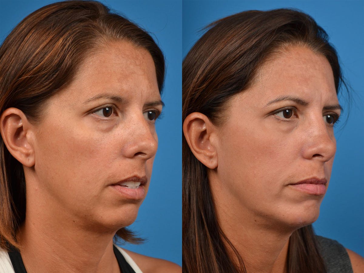 Rhinoplasty Before & After Gallery - Patient 122406877 - Image 2