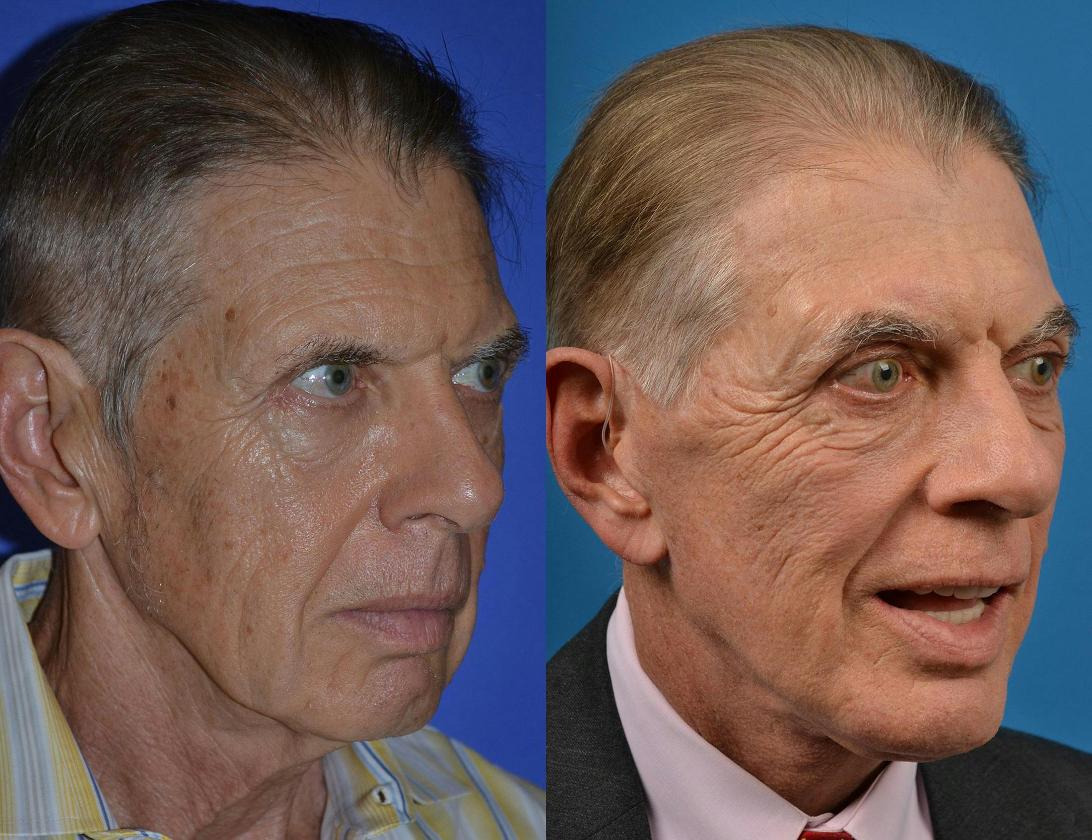 Skin Resurfacing Before & After Gallery - Patient 122406879 - Image 2