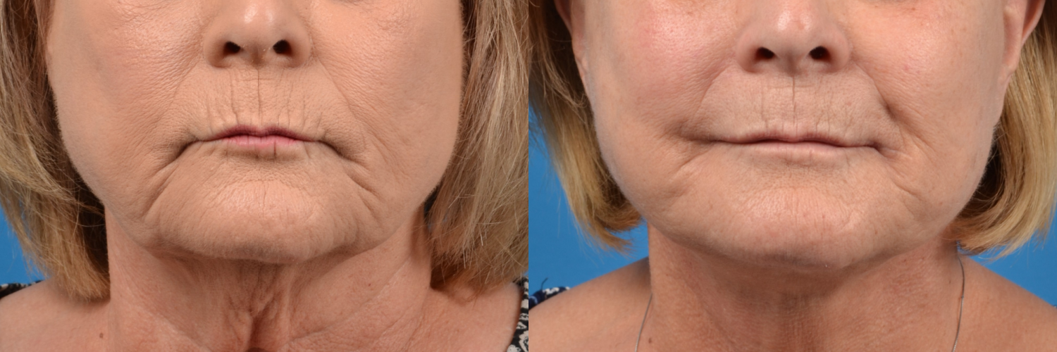 Lip Lift Before & After Gallery - Patient 122406878 - Image 1