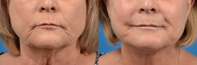 Lip Lift Before & After Gallery - Patient 122406878 - Image 1