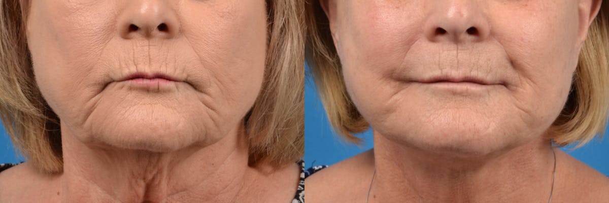 Lip Lift Before & After Gallery - Patient 122406878 - Image 1