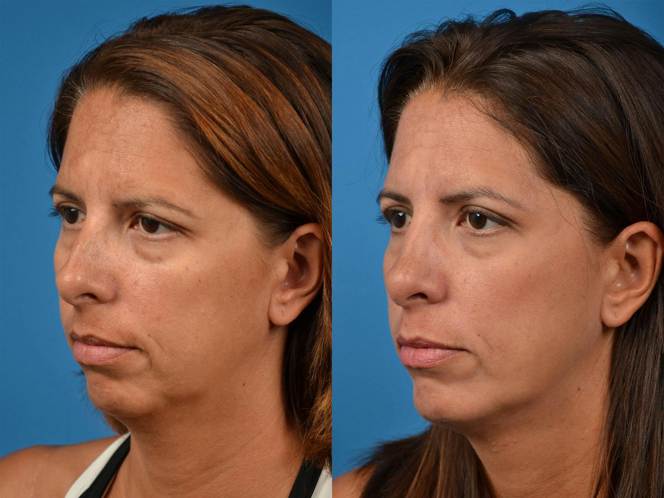 Rhinoplasty Before & After Gallery - Patient 122406877 - Image 4