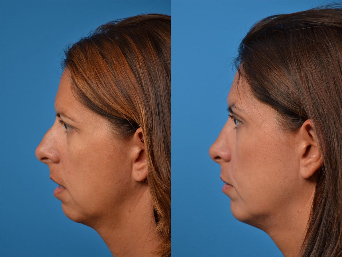 Rhinoplasty Before & After Gallery - Patient 122406877 - Image 5