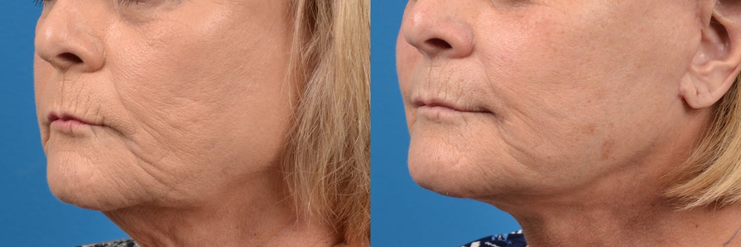 Lip Lift Before & After Gallery - Patient 122406878 - Image 2