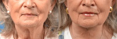 Lip Lift Before & After Gallery - Patient 122406880 - Image 1