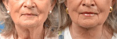 Lip Lift Before & After Gallery - Patient 122406880 - Image 1