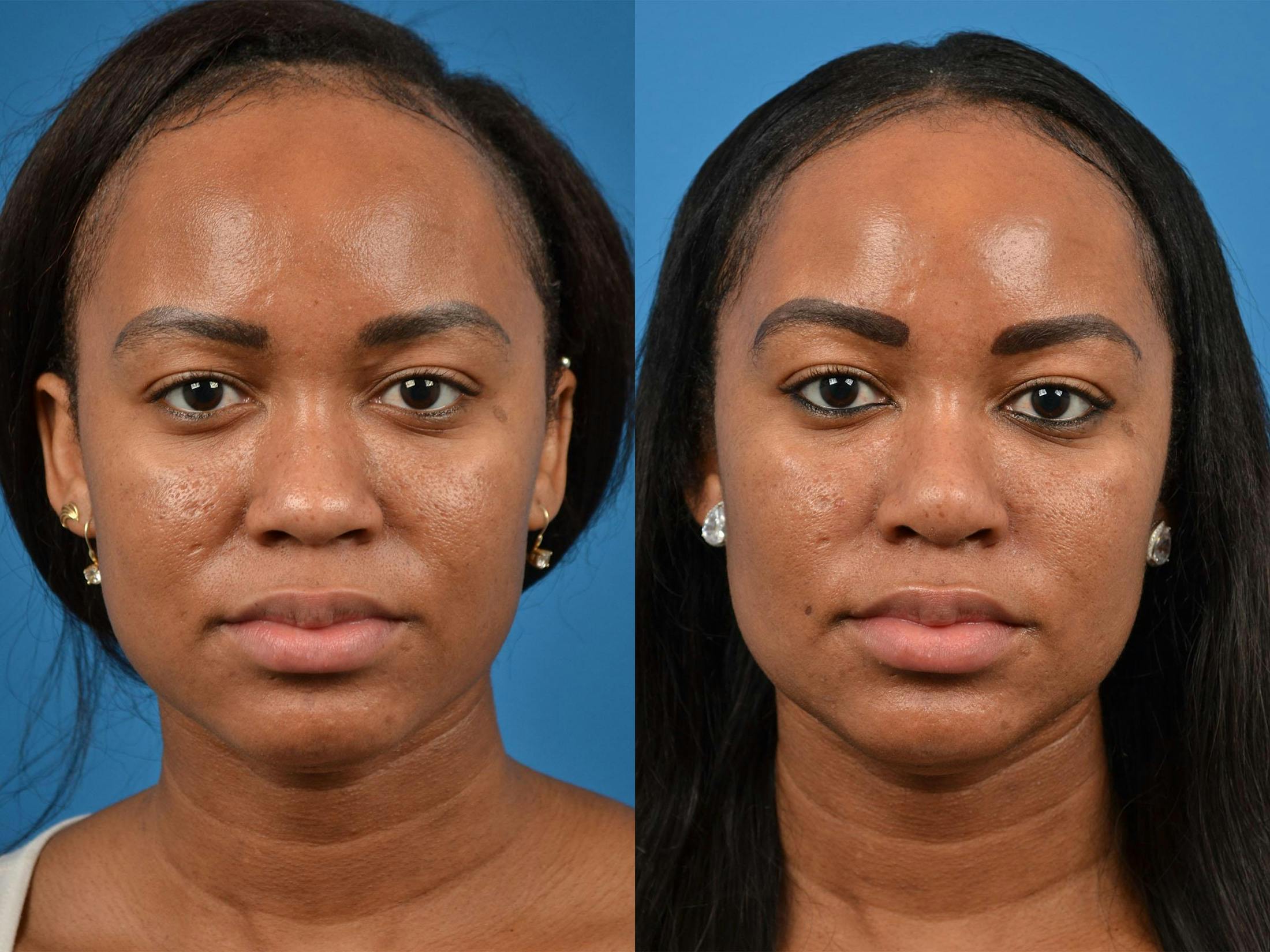 Rhinoplasty Before & After Gallery - Patient 122406883 - Image 1