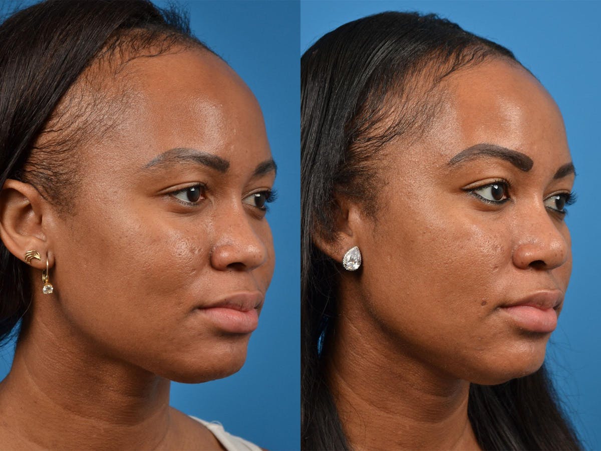 Rhinoplasty Before & After Gallery - Patient 122406883 - Image 2