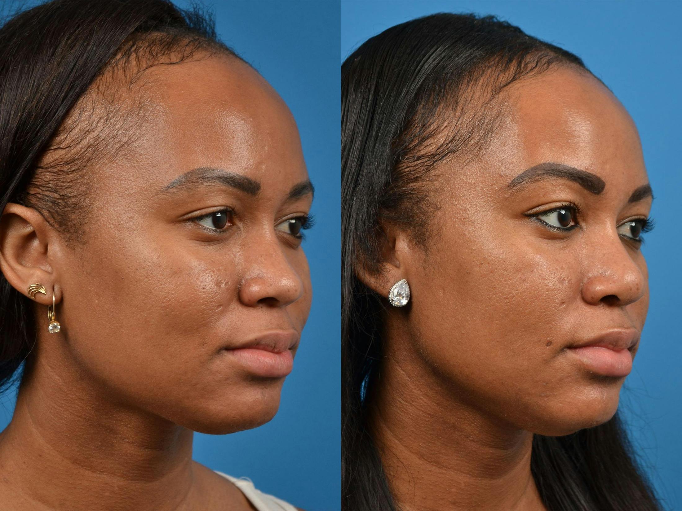 Rhinoplasty Before & After Gallery - Patient 122406883 - Image 2