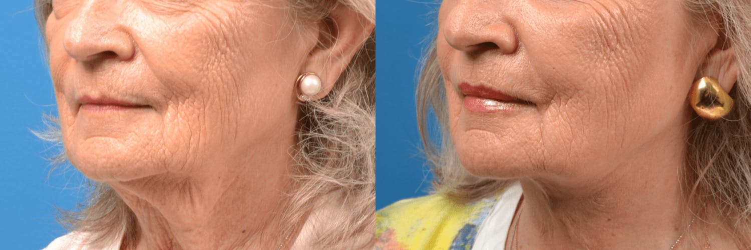 Lip Lift Before & After Gallery - Patient 122406880 - Image 2
