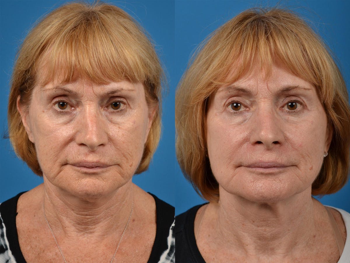 Skin Resurfacing Before & After Gallery - Patient 122406887 - Image 1