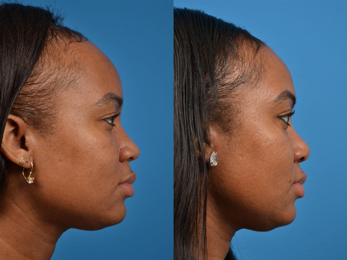 Rhinoplasty Before & After Gallery - Patient 122406883 - Image 3