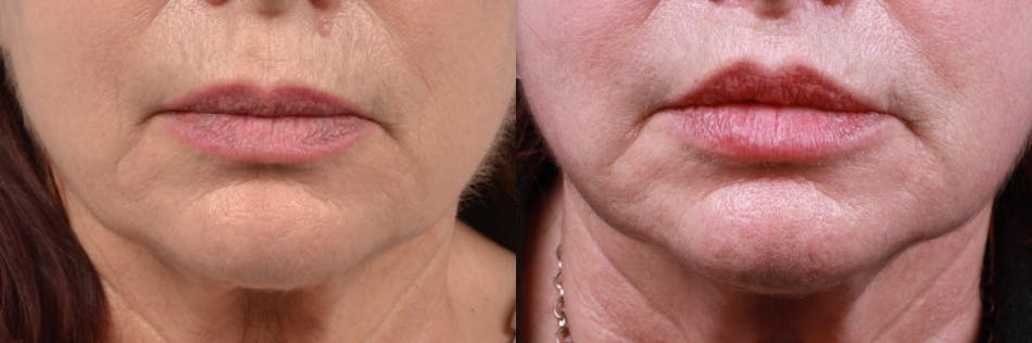 Lip Lift Before & After Gallery - Patient 122406881 - Image 1