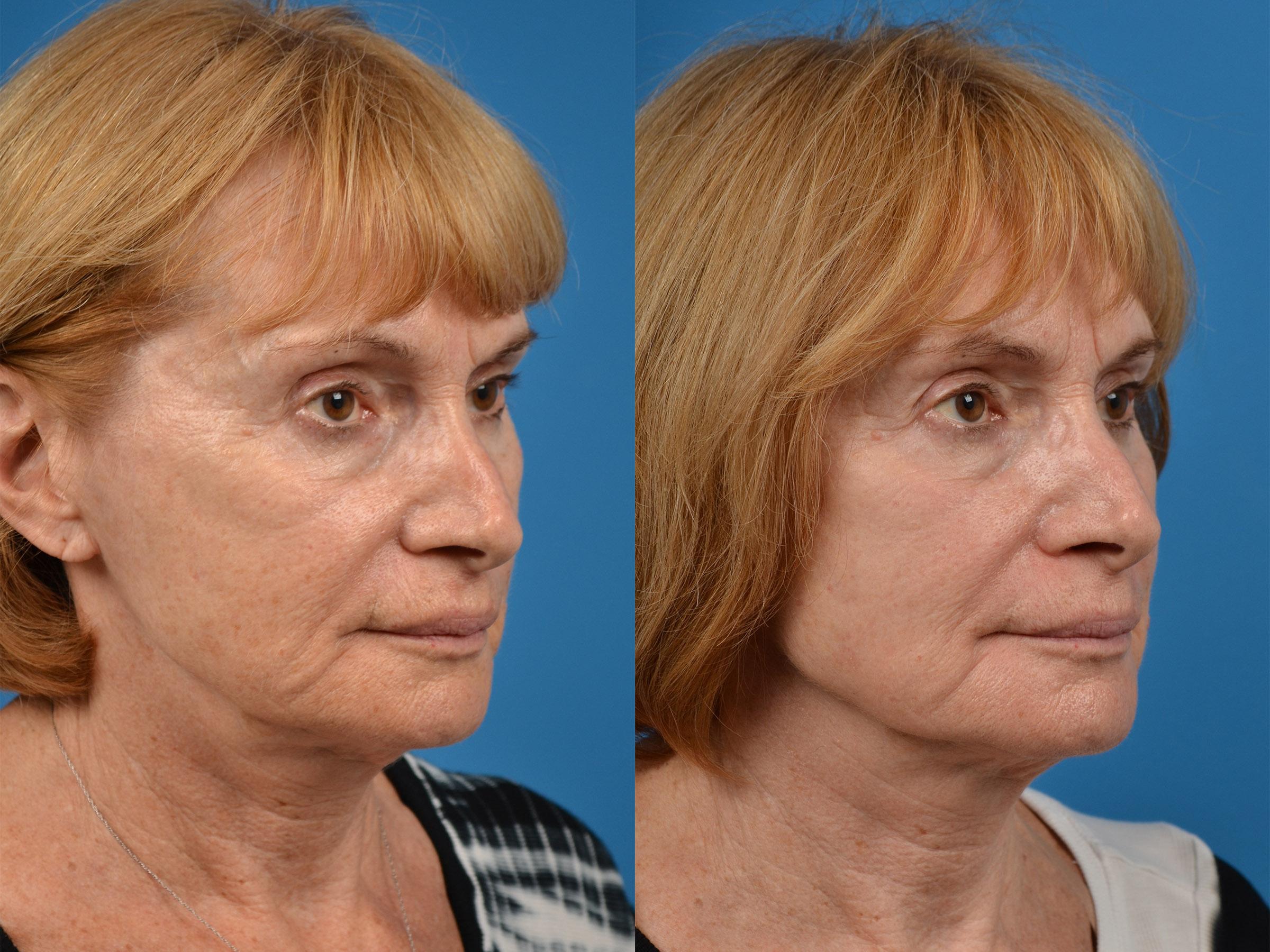 Skin Resurfacing Before & After Gallery - Patient 122406887 - Image 2