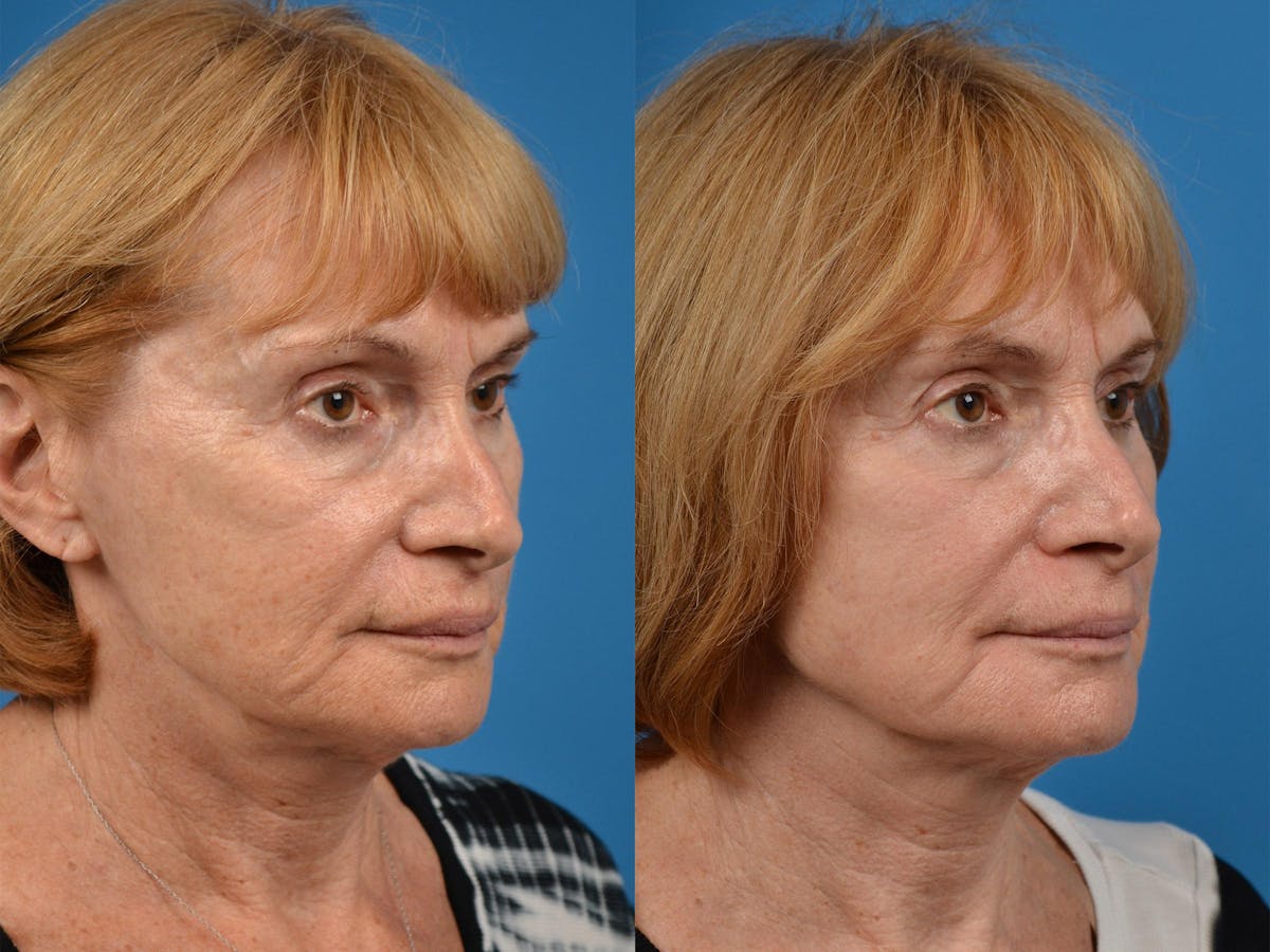 Skin Resurfacing Before & After Gallery - Patient 122406887 - Image 2