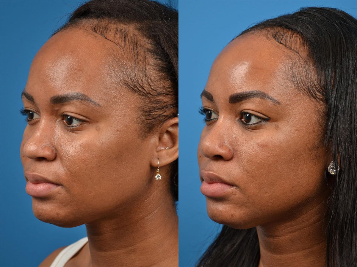 Rhinoplasty Before & After Gallery - Patient 122406883 - Image 4