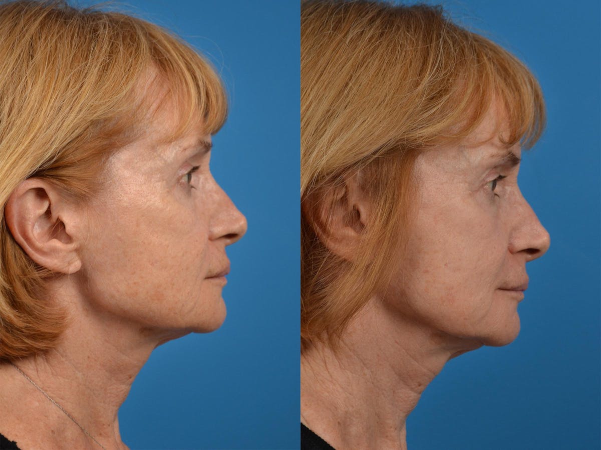 Skin Resurfacing Before & After Gallery - Patient 122406887 - Image 3