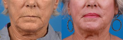 Lip Lift Before & After Gallery - Patient 122406885 - Image 1