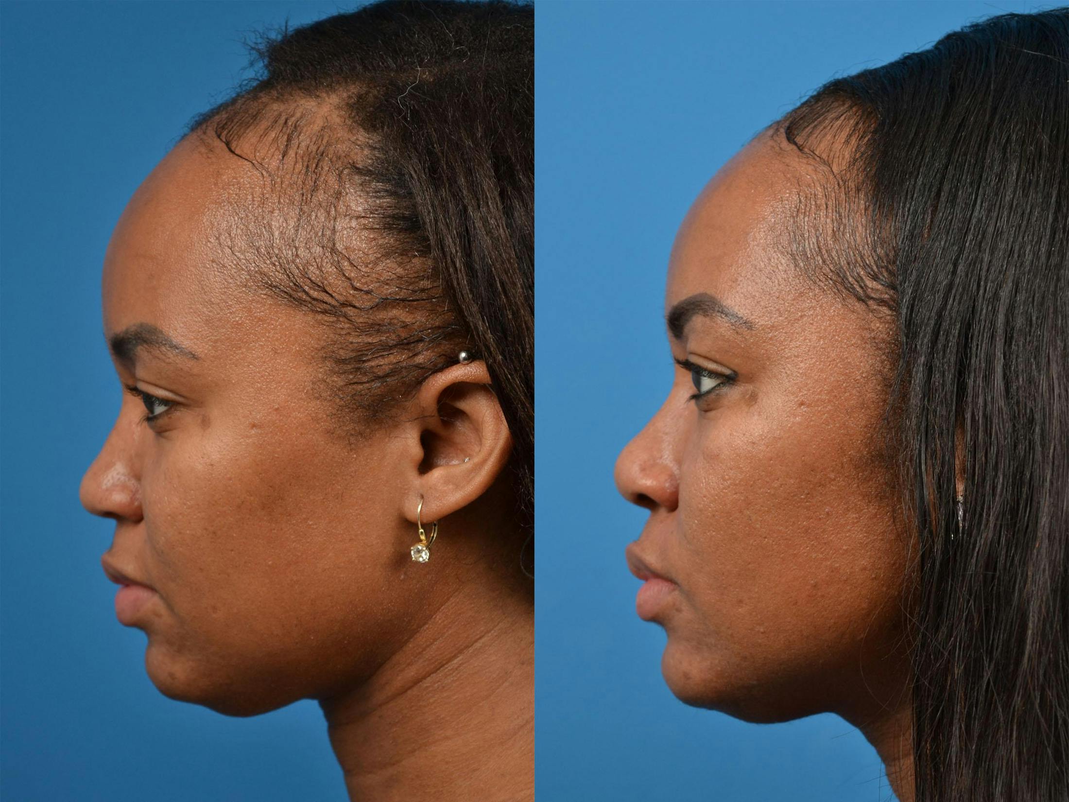 Rhinoplasty Before & After Gallery - Patient 122406883 - Image 5