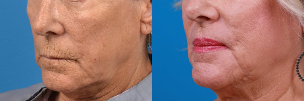 Lip Lift Before & After Gallery - Patient 122406885 - Image 2