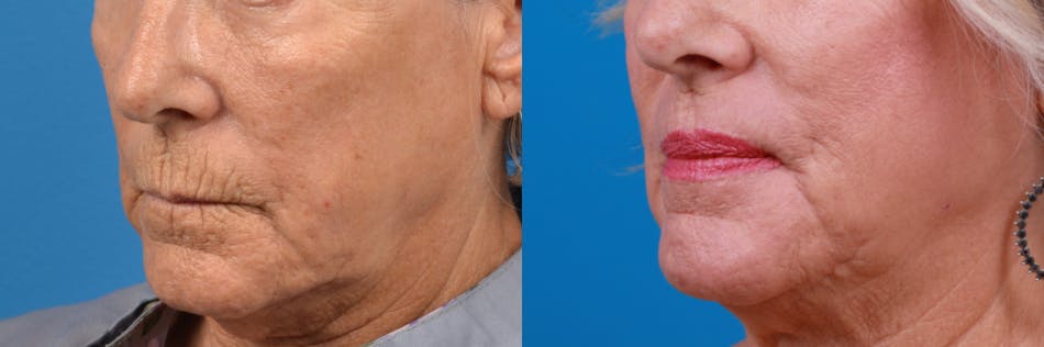 Lip Lift Before & After Gallery - Patient 122406885 - Image 2