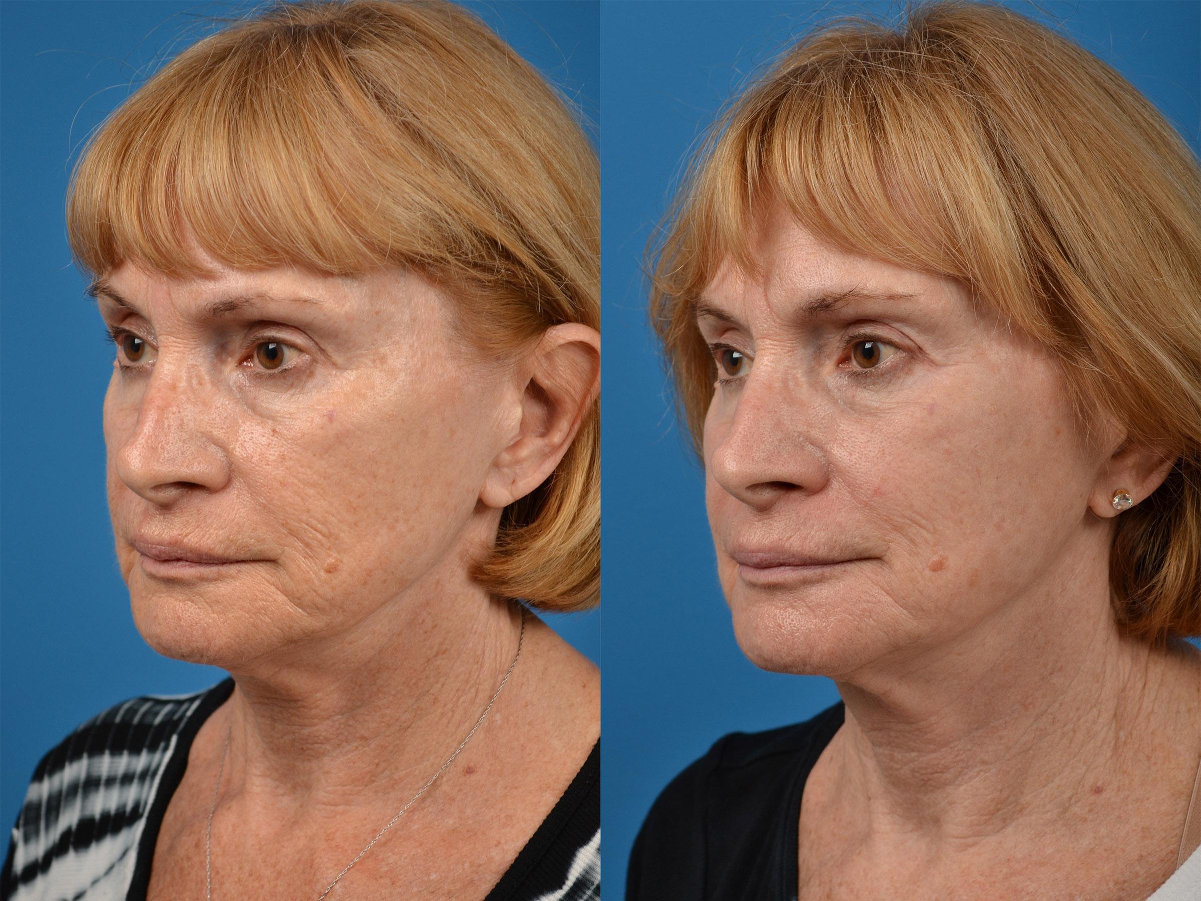 Skin Resurfacing Before & After Gallery - Patient 122406887 - Image 4