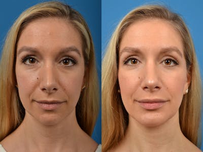 Rhinoplasty Before & After Gallery - Patient 122406888 - Image 1