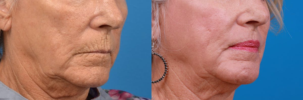 Lip Lift Before & After Gallery - Patient 122406885 - Image 3