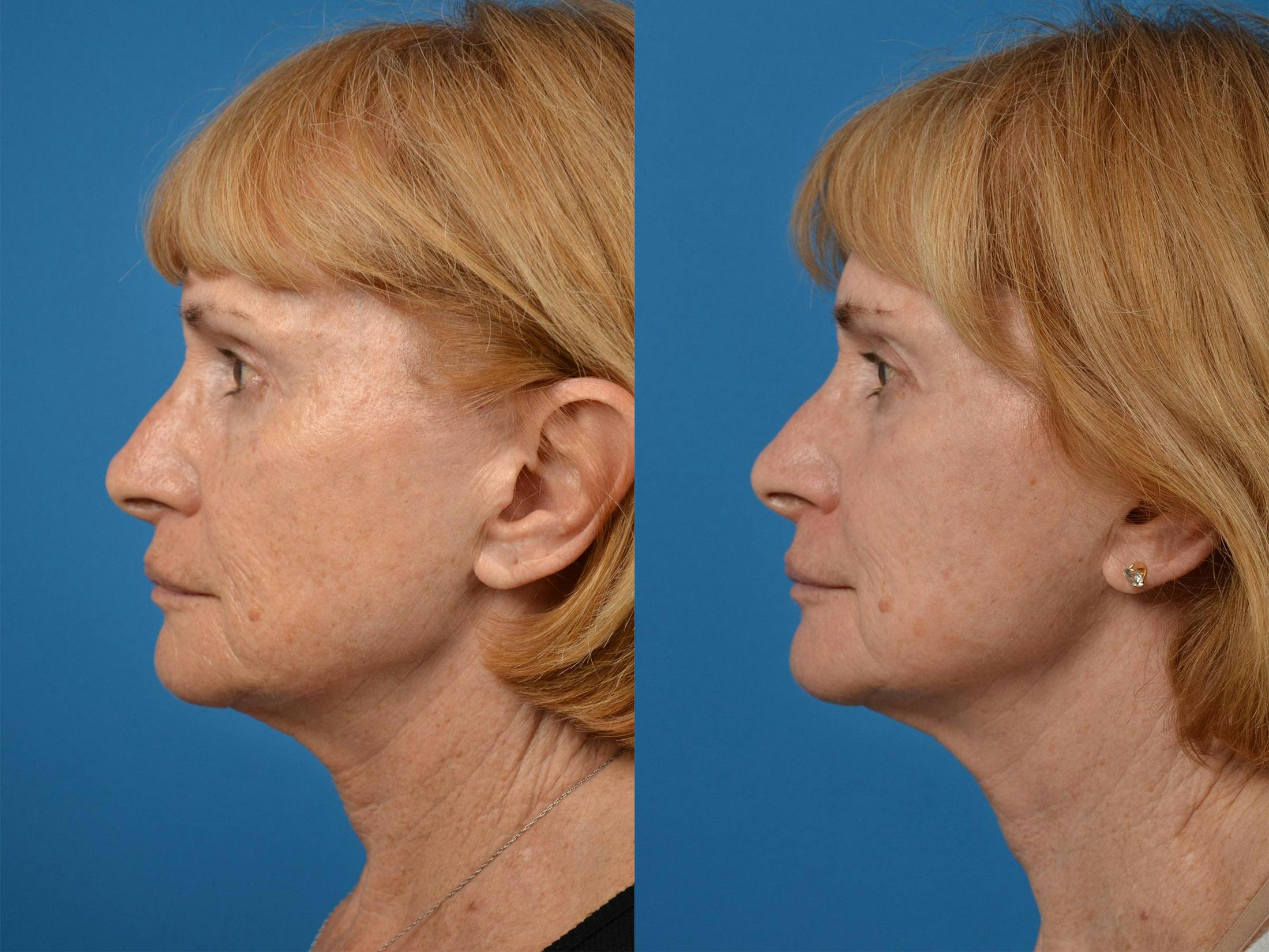 Skin Resurfacing Before & After Gallery - Patient 122406887 - Image 5