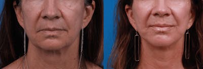 Lip Lift Before & After Gallery - Patient 122406886 - Image 1