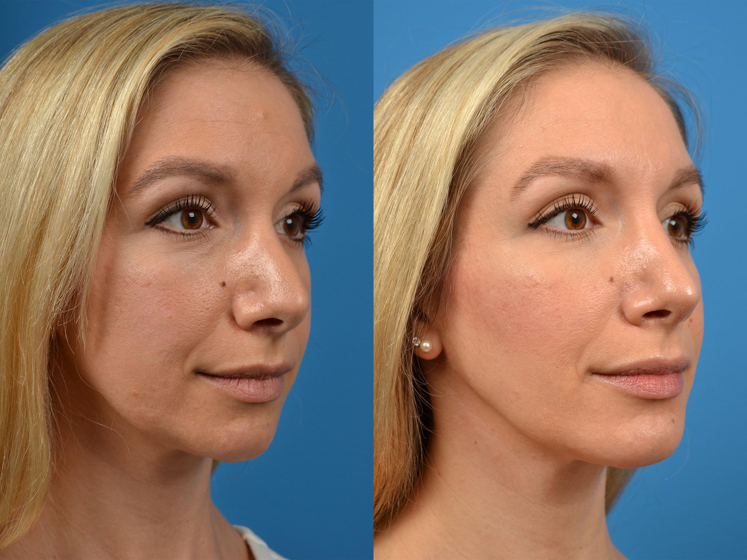 Rhinoplasty Before & After Gallery - Patient 122406888 - Image 2