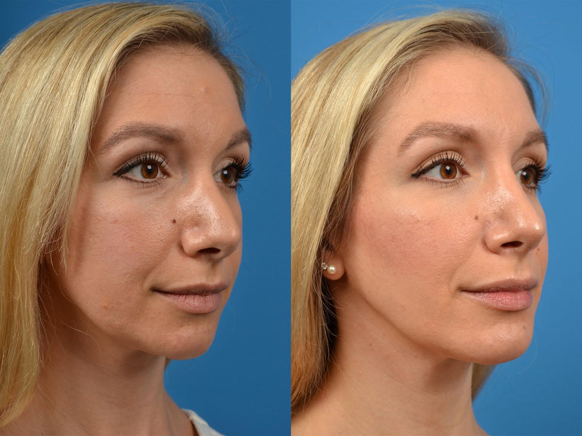 Rhinoplasty Before & After Gallery - Patient 122406888 - Image 2