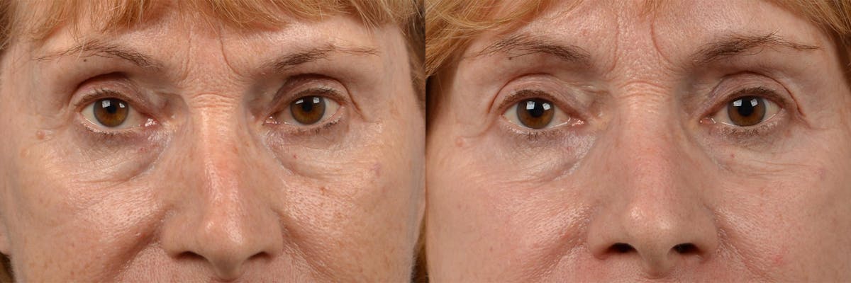 Skin Resurfacing Before & After Gallery - Patient 122406887 - Image 6