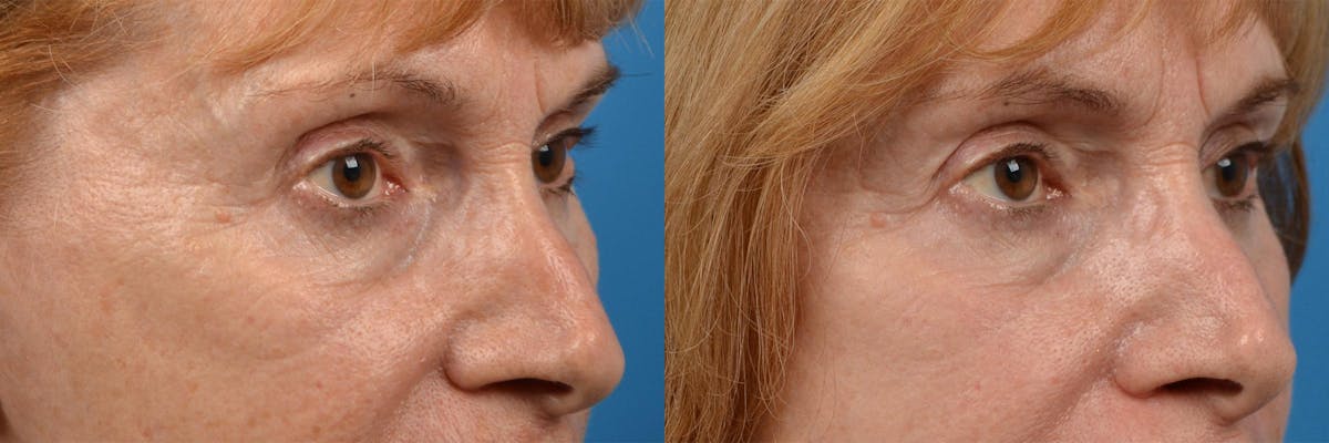 Skin Resurfacing Before & After Gallery - Patient 122406887 - Image 7