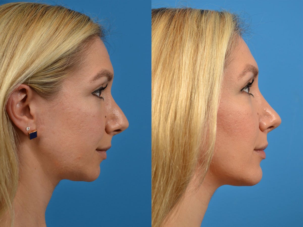 Rhinoplasty Before & After Gallery - Patient 122406888 - Image 3