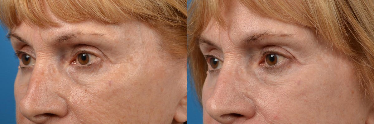 Skin Resurfacing Before & After Gallery - Patient 122406887 - Image 8
