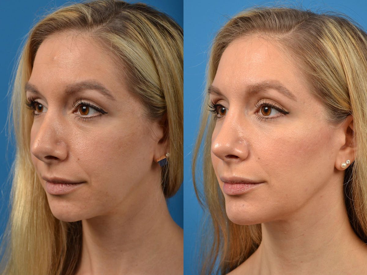 Rhinoplasty Before & After Gallery - Patient 122406888 - Image 4