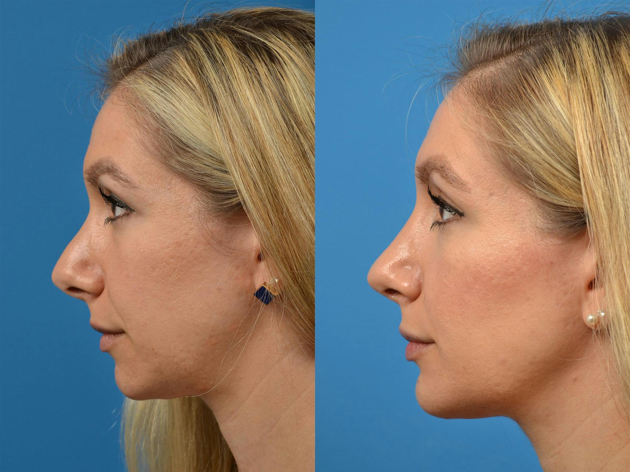 Rhinoplasty Before & After Gallery - Patient 122406888 - Image 5