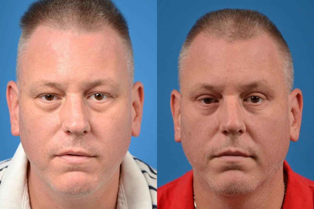 Skin Resurfacing Before & After Gallery - Patient 122406892 - Image 1