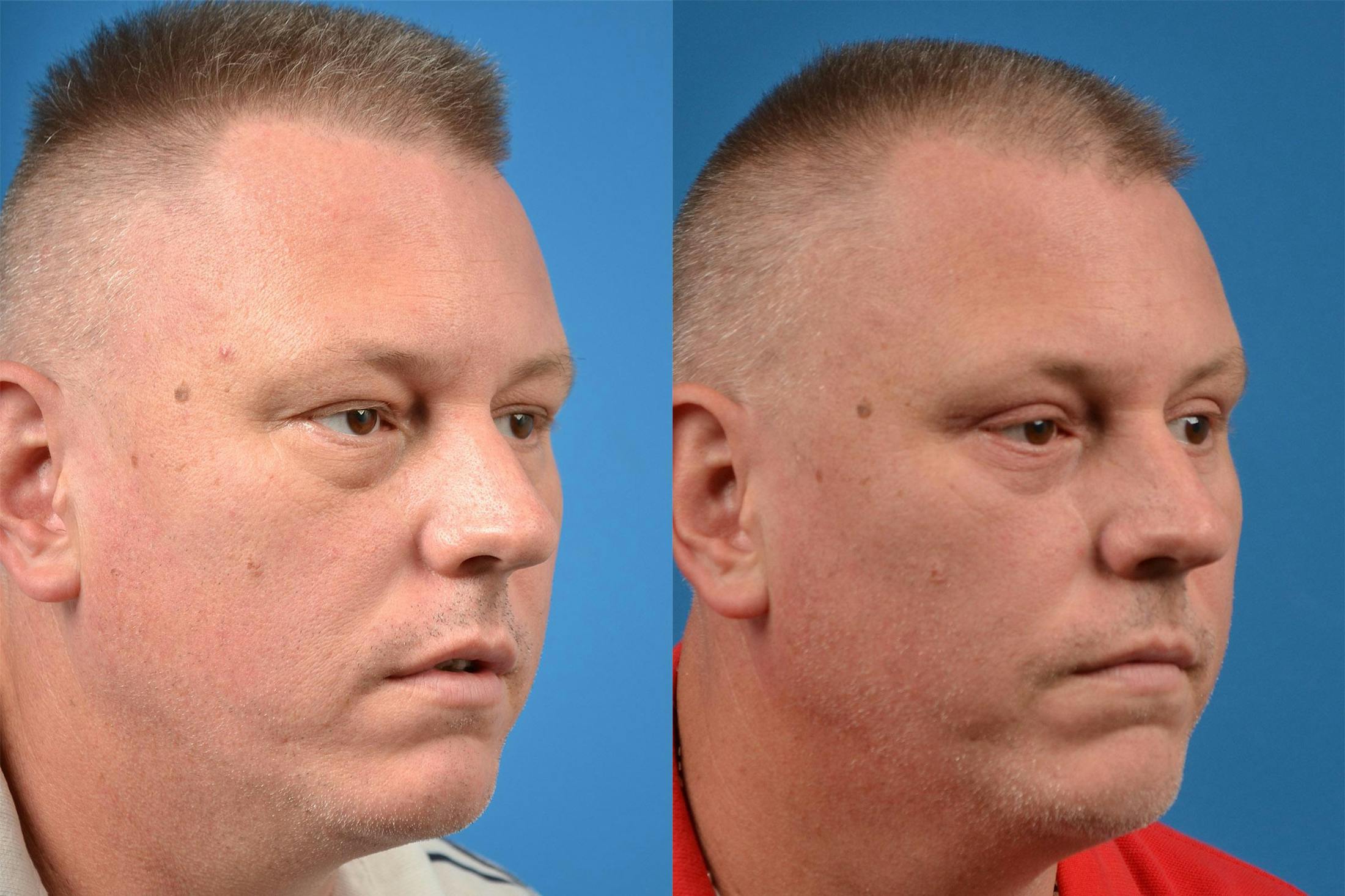 Skin Resurfacing Before & After Gallery - Patient 122406892 - Image 2