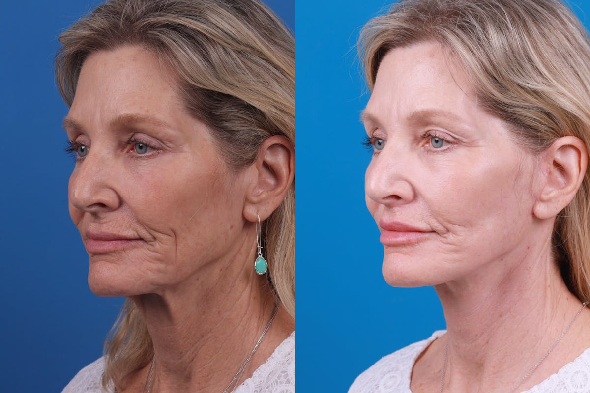 Lip Lift Before & After Gallery - Patient 122406908 - Image 2