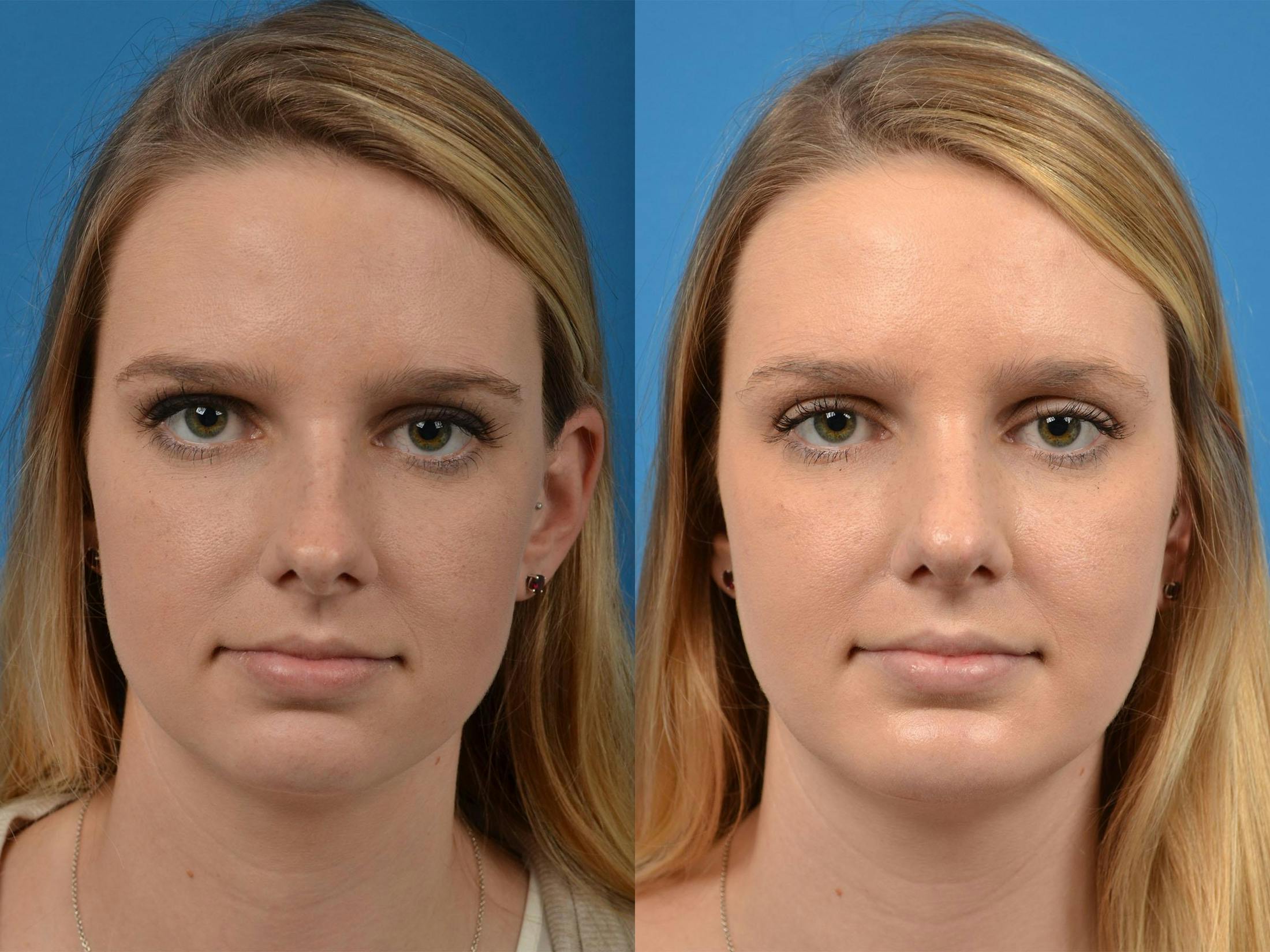 Rhinoplasty Before & After Gallery - Patient 122406891 - Image 1