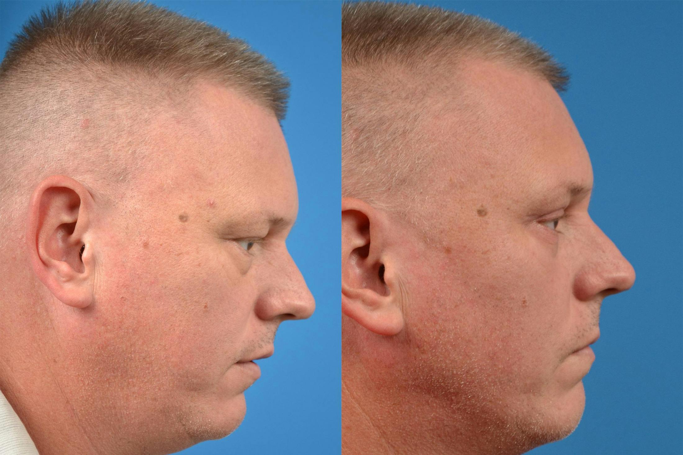 Skin Resurfacing Before & After Gallery - Patient 122406892 - Image 3