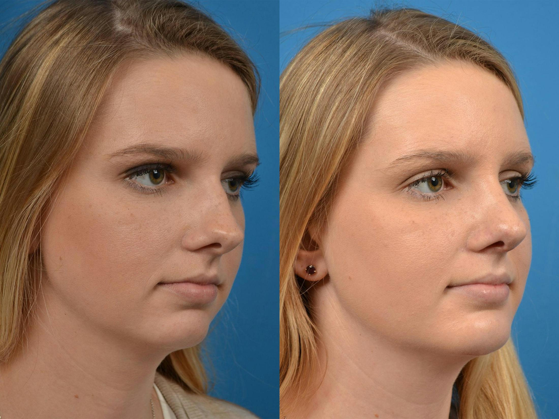 Rhinoplasty Before & After Gallery - Patient 122406891 - Image 2