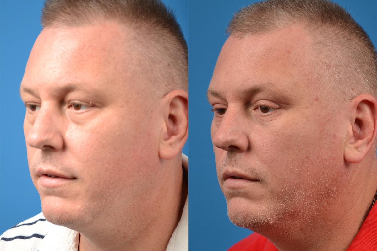 Skin Resurfacing Before & After Gallery - Patient 122406892 - Image 4