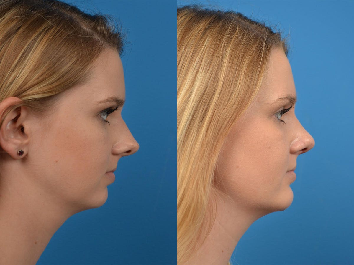 Rhinoplasty Before & After Gallery - Patient 122406891 - Image 3